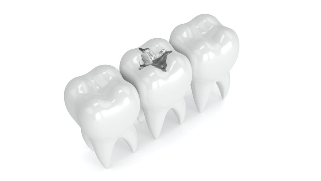 ترمیم آمالگام (غیر همرنگ)